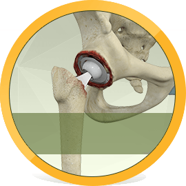 Revision Joint Replacement