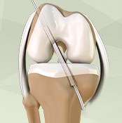 Joint Reconstruction