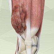 Musculoskeletal Tumors