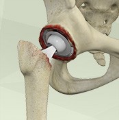 Revision Joint Replacement