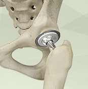 Total Hip Replacement