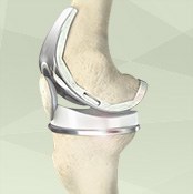 Total Knee Replacement