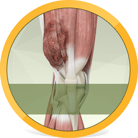 Musculoskeletal Tumors