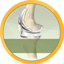 Total Knee Replacement