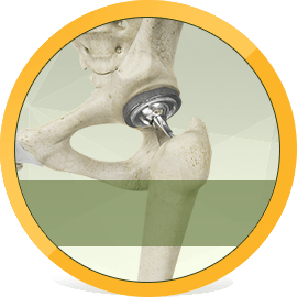 Total Hip Replacement