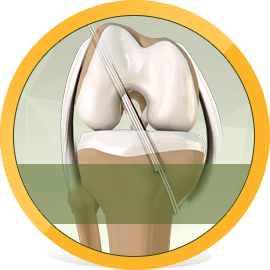 Bone and Joint Reconstruction